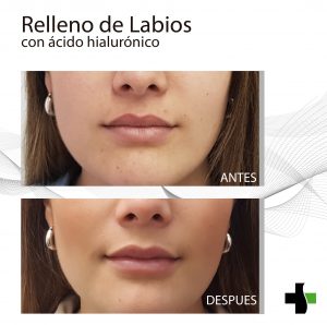 Relleno ácido hialurónico precio argentina 2019 Relleno ácido hialurónico precio argentina 2019